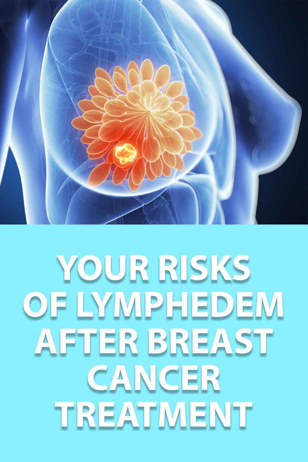 Your Risks Of Lymphedema After Breast Cancer Treatment 